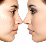 Traitement des imperfections du visage