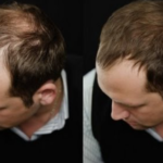 Traitement contre la calvitie