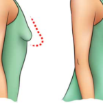 L'augmentation des seins