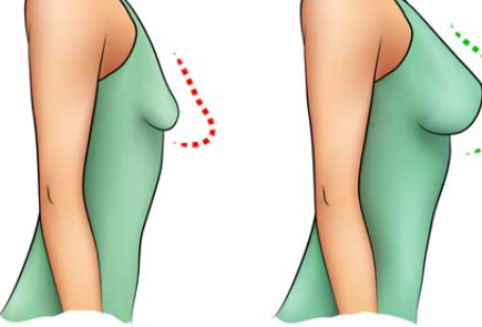 L'augmentation des seins