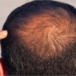 resoudre-la-calvitie