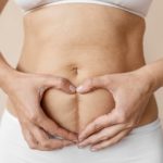 Pourquoi faire une abdominoplastie ?