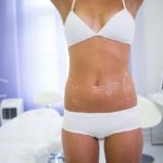 Lecture utile sur l’abdominoplastie en chirurgie esthétique