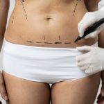 Mon abdominoplastie est loupée que faire ?